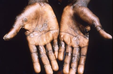A Black person's hands, facing palms up, covered with blisters caused by monkeypox