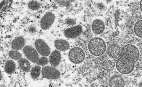 Monkeypox virus as seen through a microscope